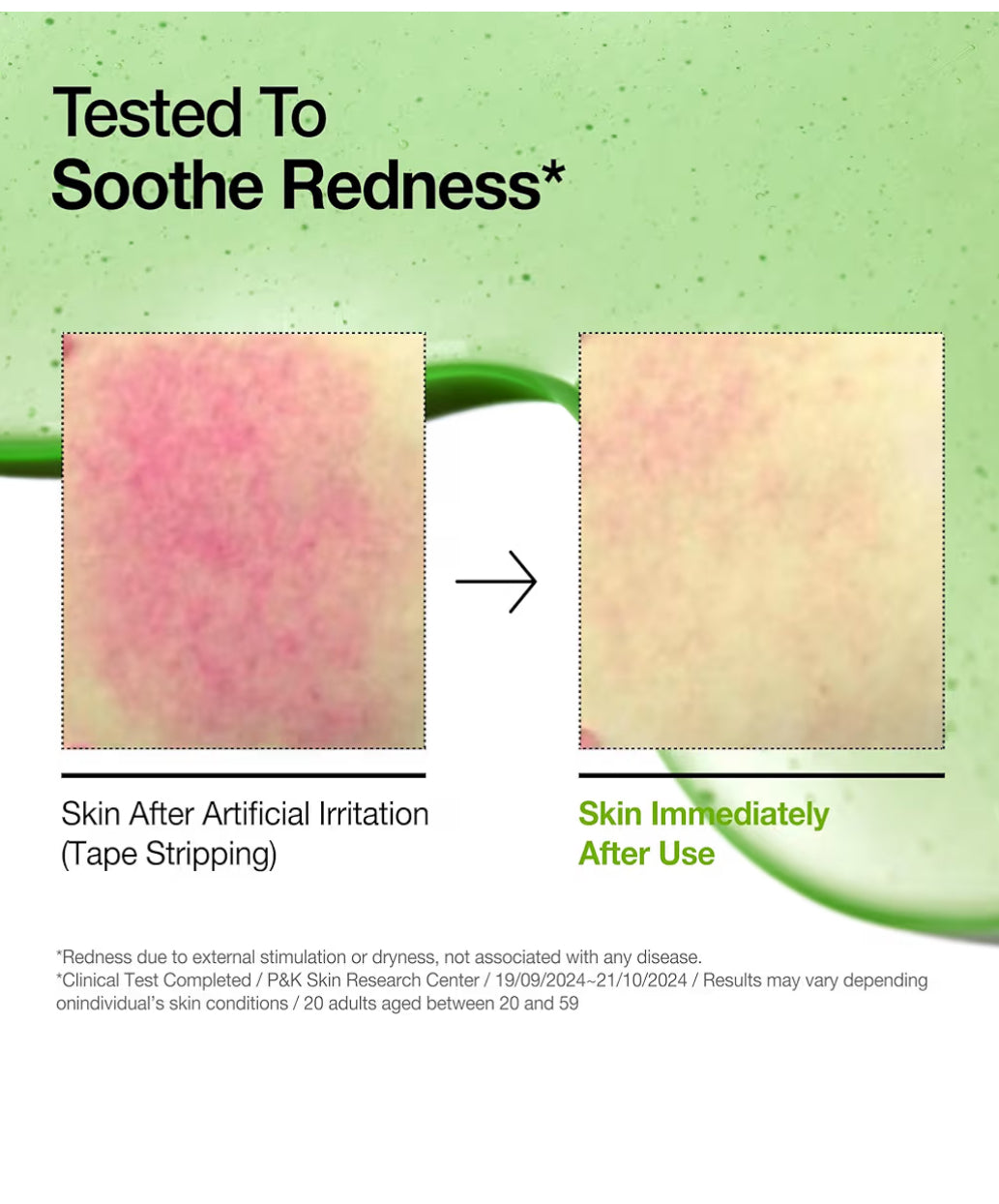 ANUA Azelaic Acid 10% Hyaluron Redness Soothing Serum (30 ml)